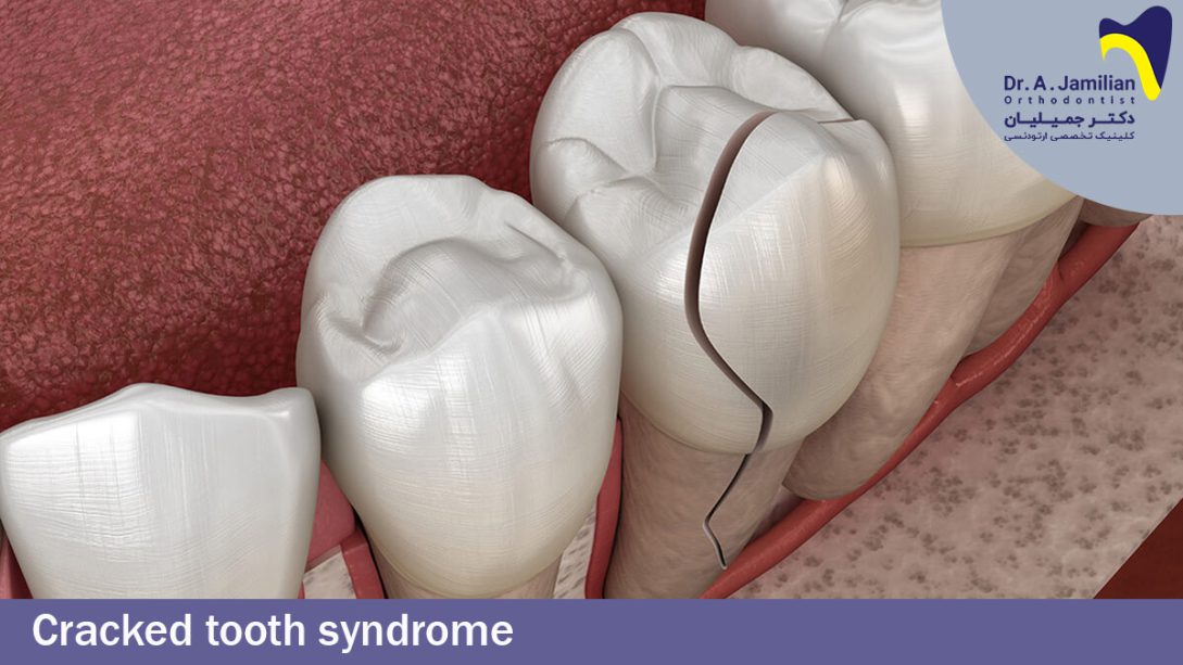 Cracked Tooth Syndrome Dr Jamilian