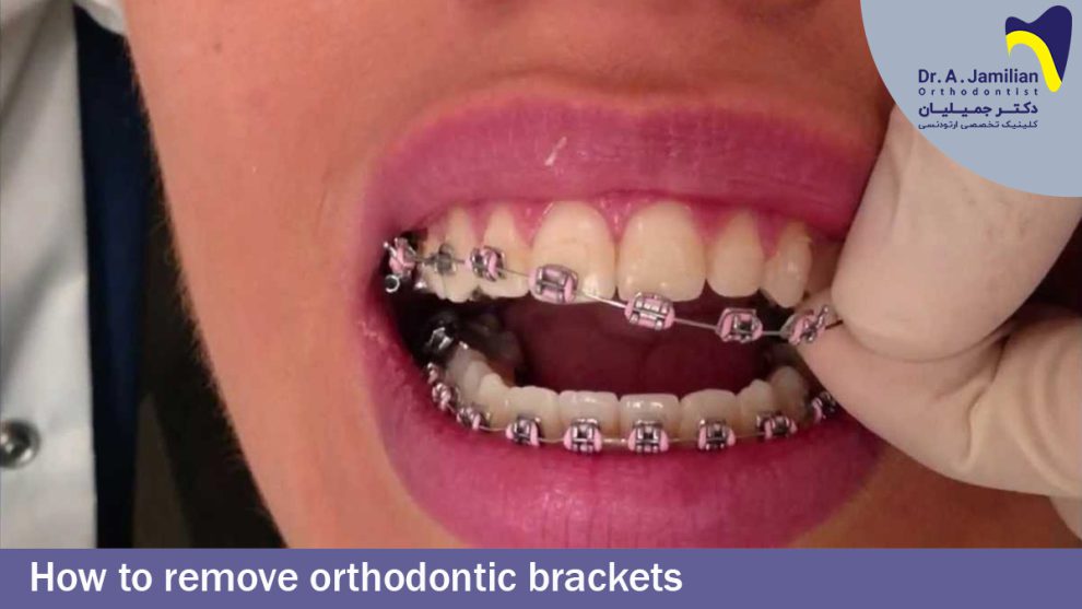 How To Remove Orthodontic Brackets Dr Jamilian