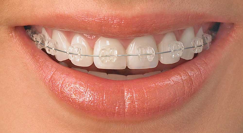 advantages of ceramic orthodontics