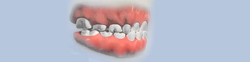 کراس بایت دندانهای قدامی