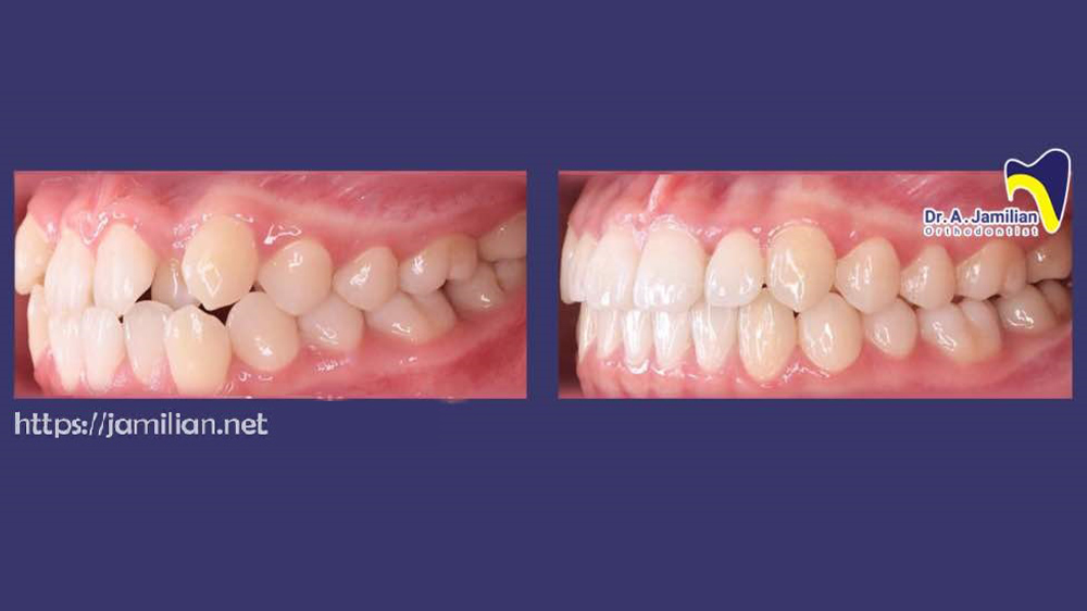before and after anterior crossbite treatment