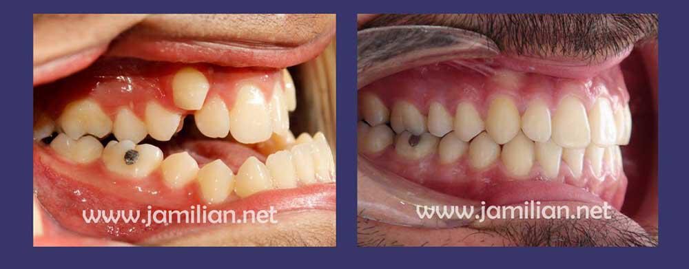 before and after orthognathic surgery