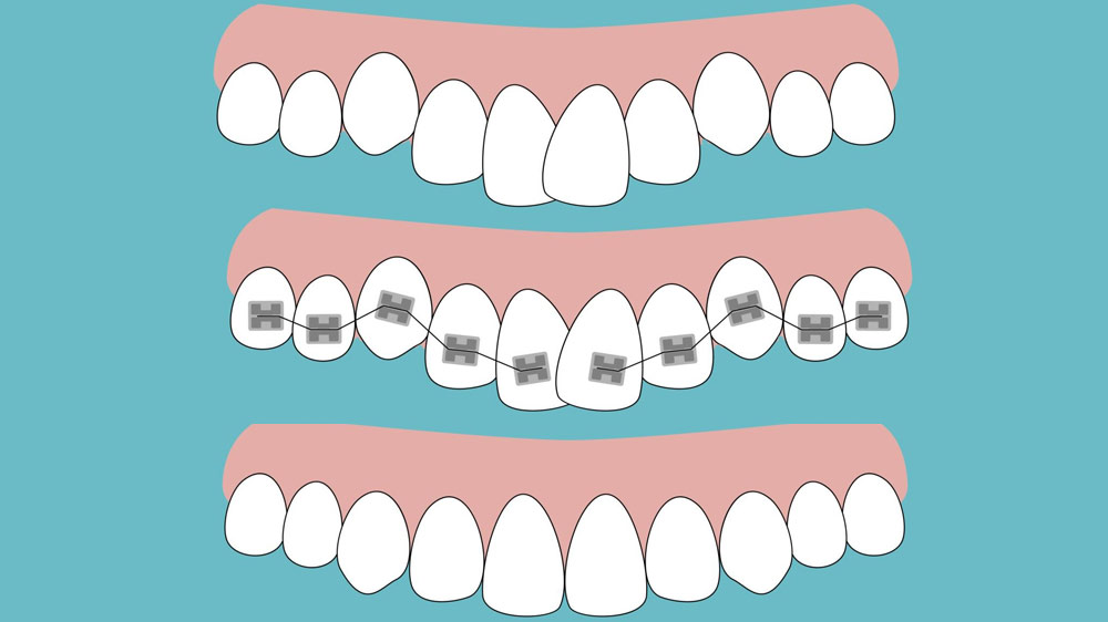 قبل وأثناء وبعد علاج تقويم الأسنان