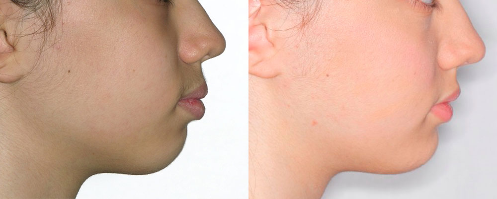 تاثیر ارتودنسی دندان بر وضعیت لب ها و چانه دختر ۱۳ ساله