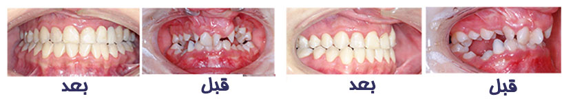 treatment of cleft palate