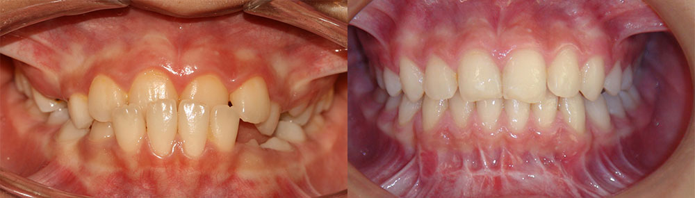 قبل و بعد درمان ارتودنسی و اصلاح نامنظمی دندان ها و دندان نهفته از نمای روبروی دندان