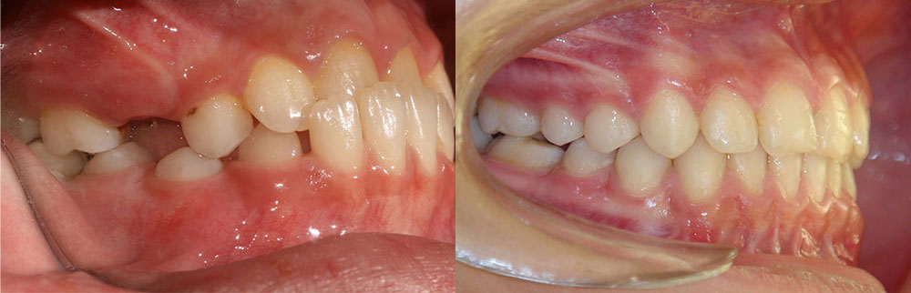 قبل و بعد درمان ارتودنسی و اصلاح نامنظمی دندان ها و دندان نهفته از نمای کناری