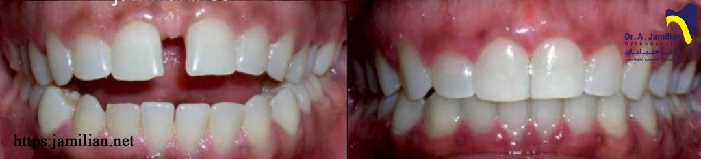 قبل وبعد علاج تقويم الأسنان المسافة بين الأسنان