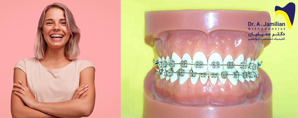 To the left is a girl smiling with fixed orthodontics and to the right is a model of fixed orthodontics