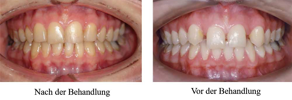 vor und nach der behandlung von zahnimplantaten