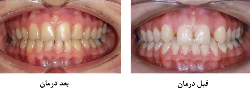 implant before and after treatment