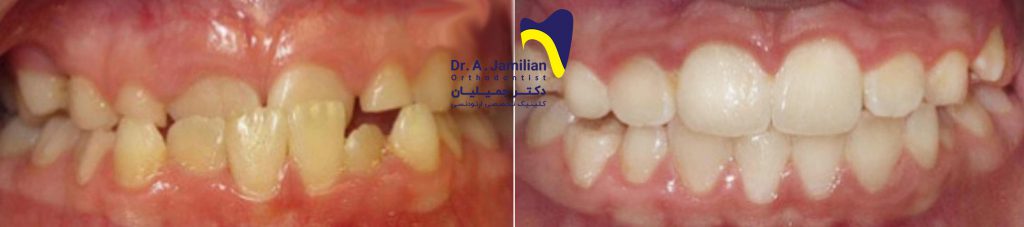 قبل وبعد العلاج التقويمي للأسنان والفك من المنظر الأمامي لمريض يعاني من عدم انتظام الأسنان والأسنان المطمورة