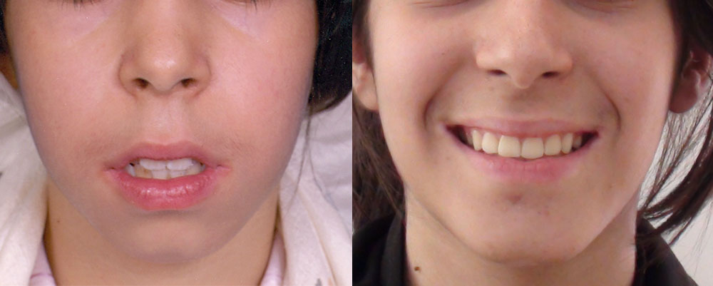 قبل و بعد اصلاح فک، لب و چانه و دندان های دختر ۱۰ ساله با ارتودنسی