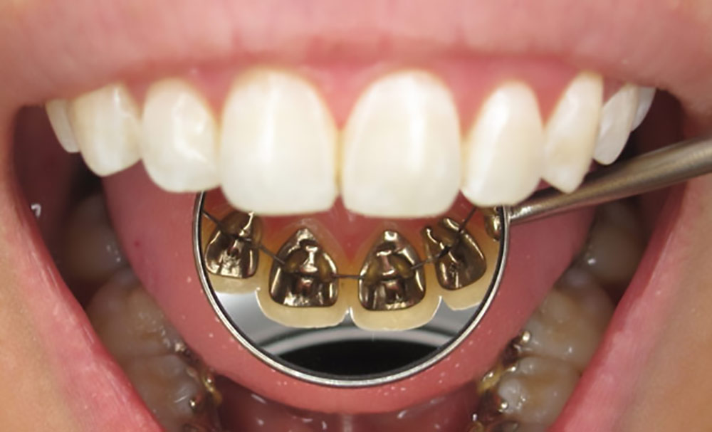 lingual orthodontics benefits