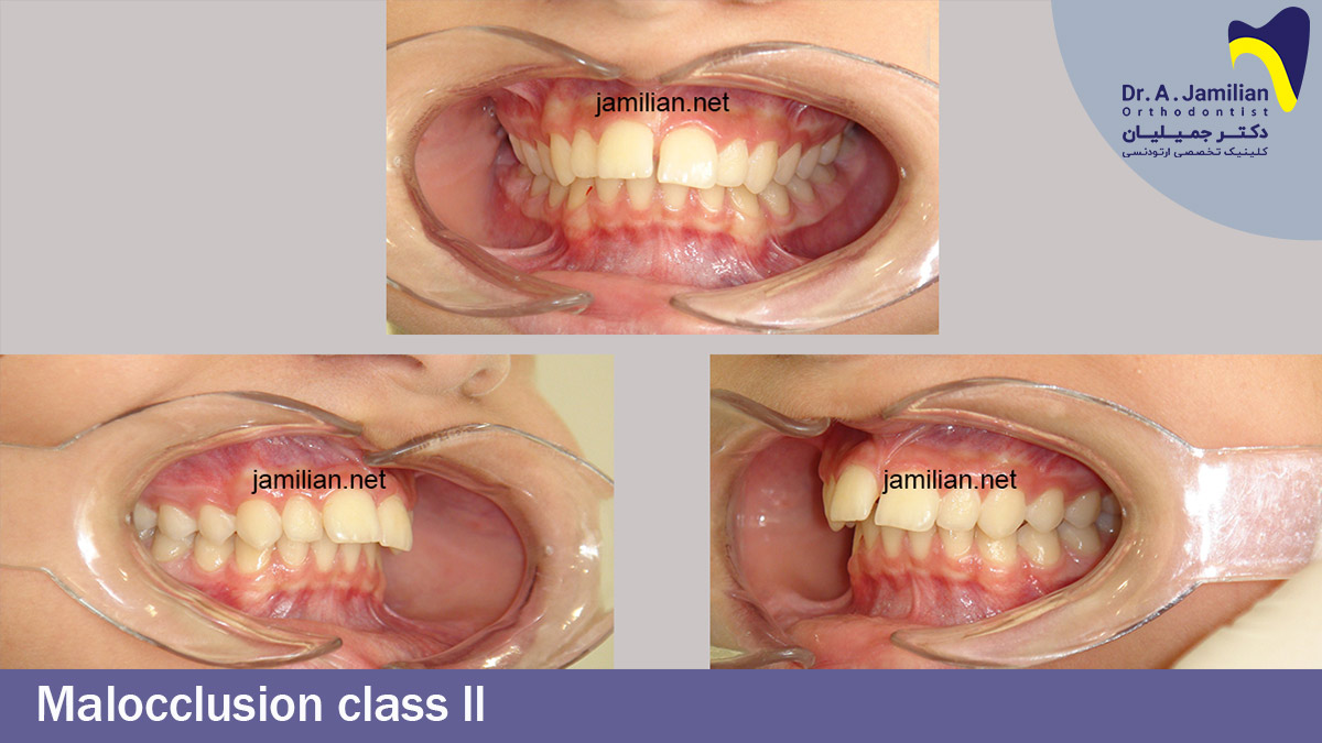 Malocclusion Class 2 - Dr Jamilian