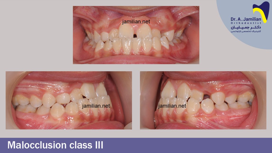 Class Iii Skeletal Malocclusion Dr Jamilian