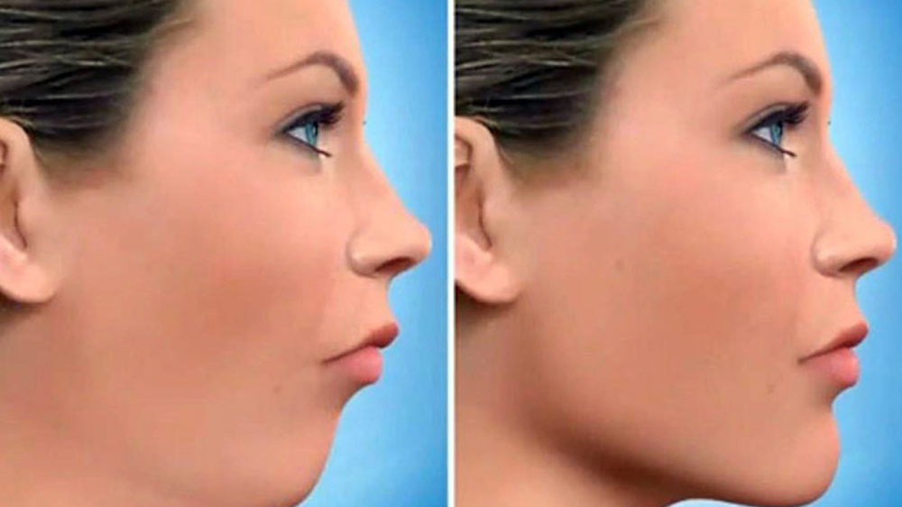 جراحی فک و صورت برای درمان اورجت