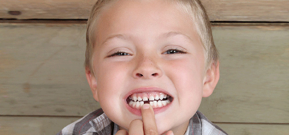 درمان دندان غایب