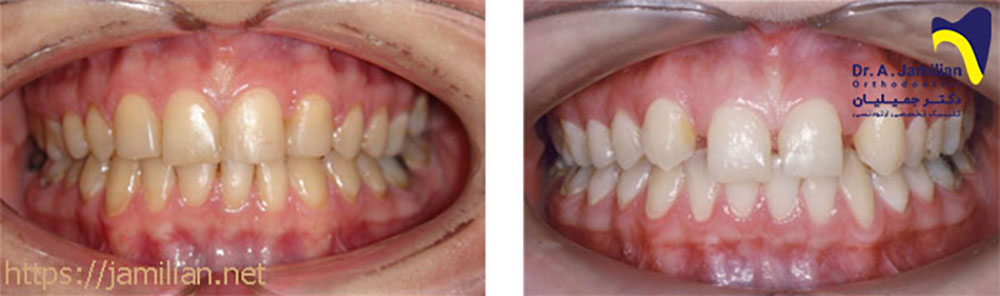 قبل بعد درمان ارتودنسی دندان غایب