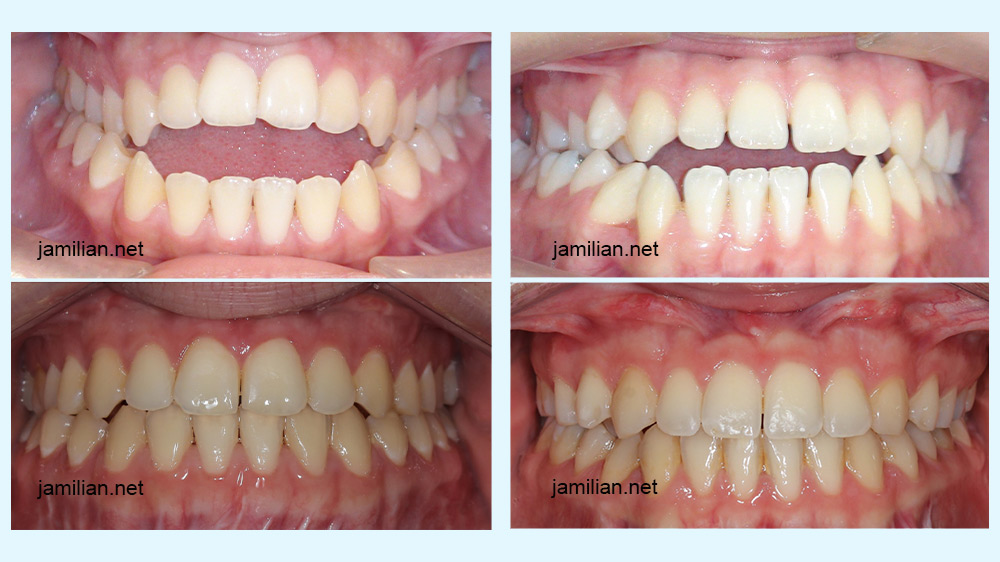 treatment of open bite malformation by dr. jamilian