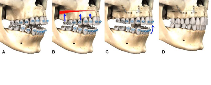 openbite and maxillofacial surgery