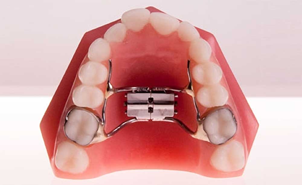جهاز تقويم الأسنان توسع لعلاج صغر وضيق الفك العلوي