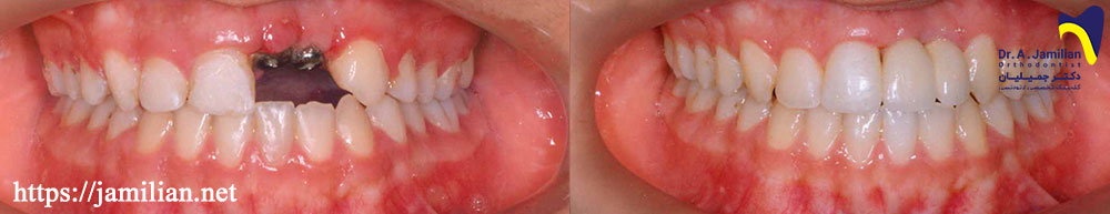 ارتودنسی و ایمپلنت دندانی