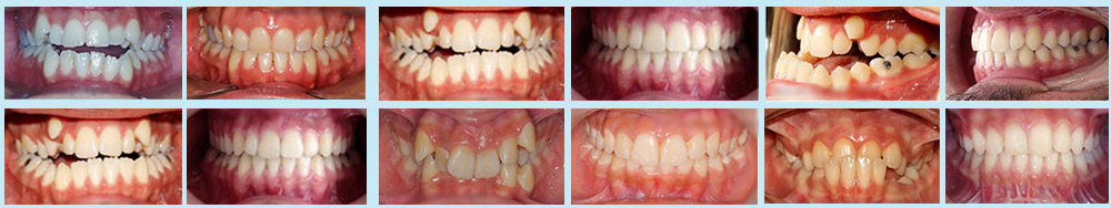 Vor und nach der kieferorthopädischen Behandlung verschiedener Kiefer- und Zahnfehlbildungen