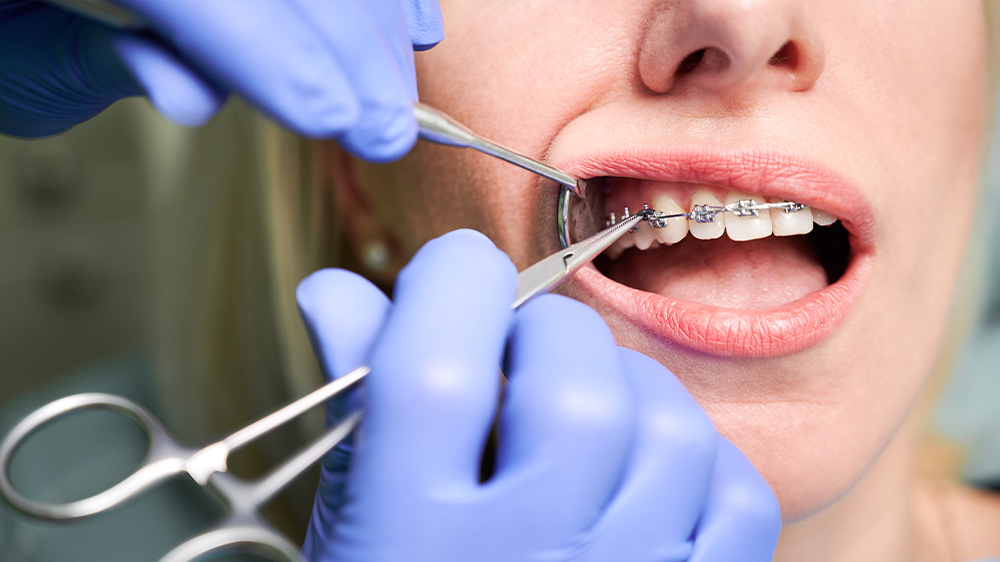 متخصص ارتودنسی در حال گذاشتن براکت ارتودنسی روی دندان بیمار است