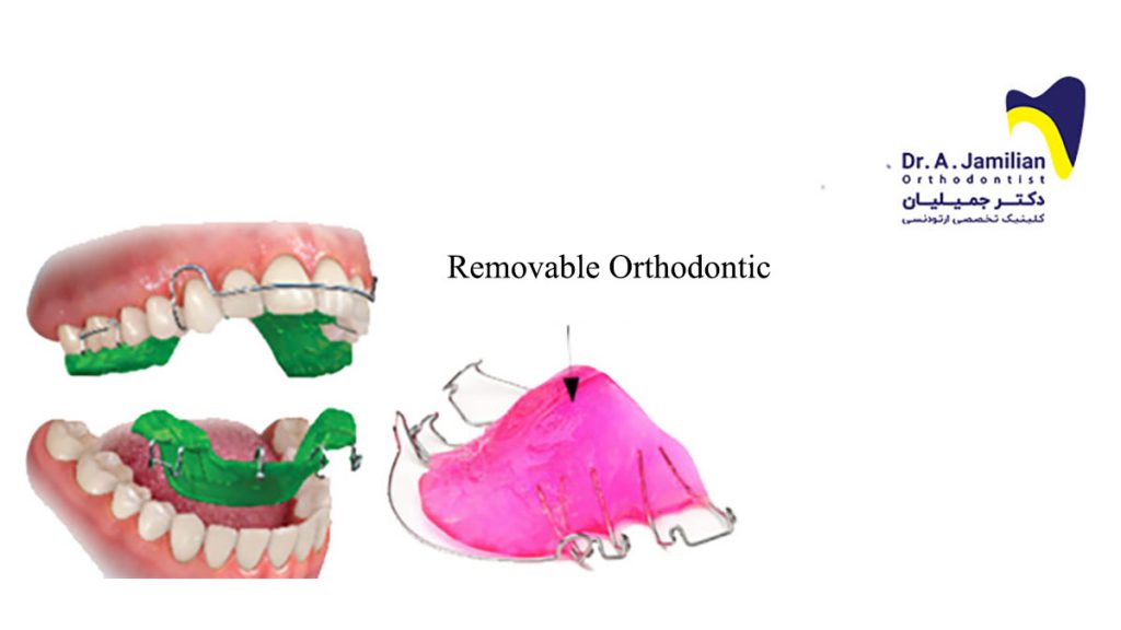 What is Removable Orthodontic Appliances Dr Jamilian