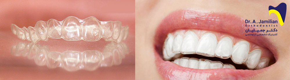 The right side of the smile with invisible orthodontics and the left orthodontic appliance