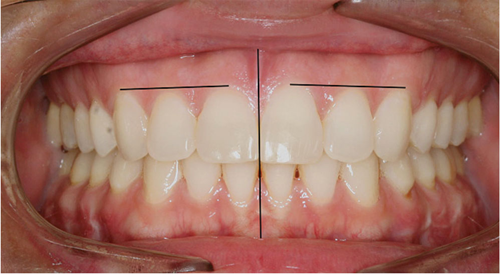 standard tooth midline