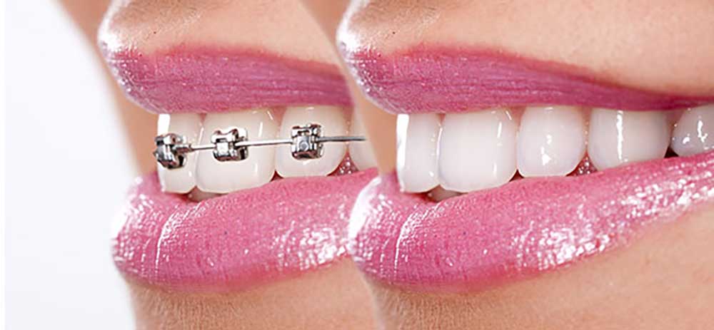 مراحل علاج تقويم الأسنان