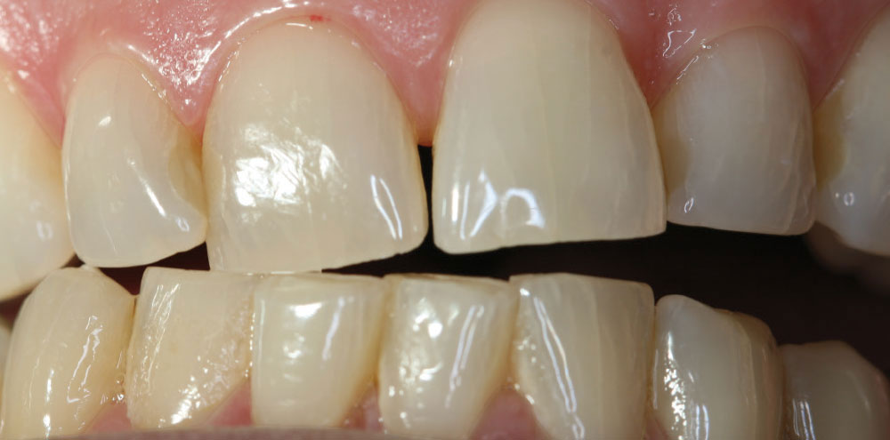 تشخيص الخط الأوسط للأسنان