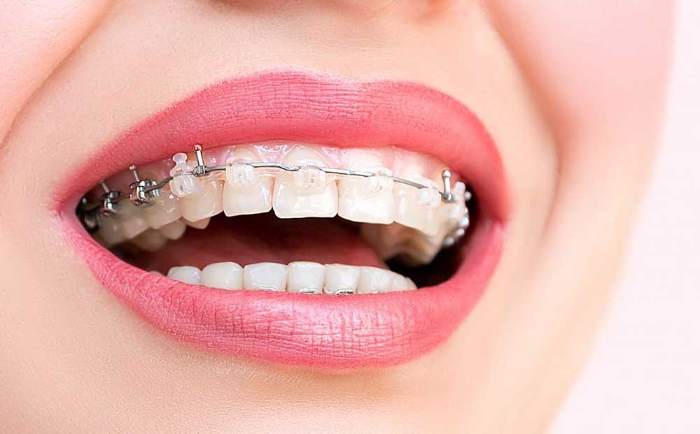time of orthodontic treatment