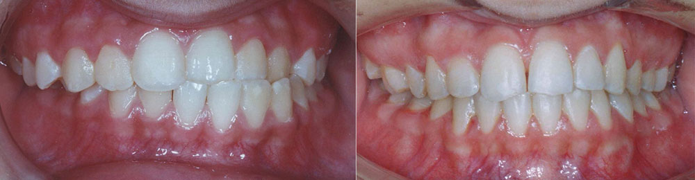 نمای روبروی قبل و بعد درمان ارتودنسی خط وسط دندان ها با ارتودنسی