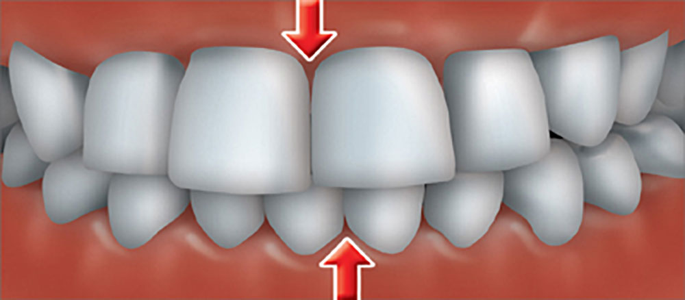identifizieren sie die fehlausrichtung der mittellinie der zähne