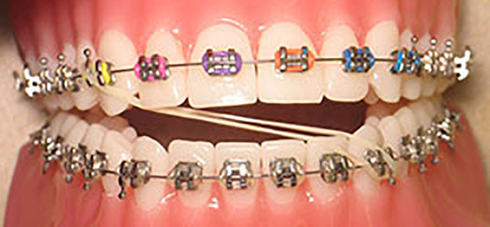درمان ارتودنسی ناهماهنگی خط وسط دندان ها