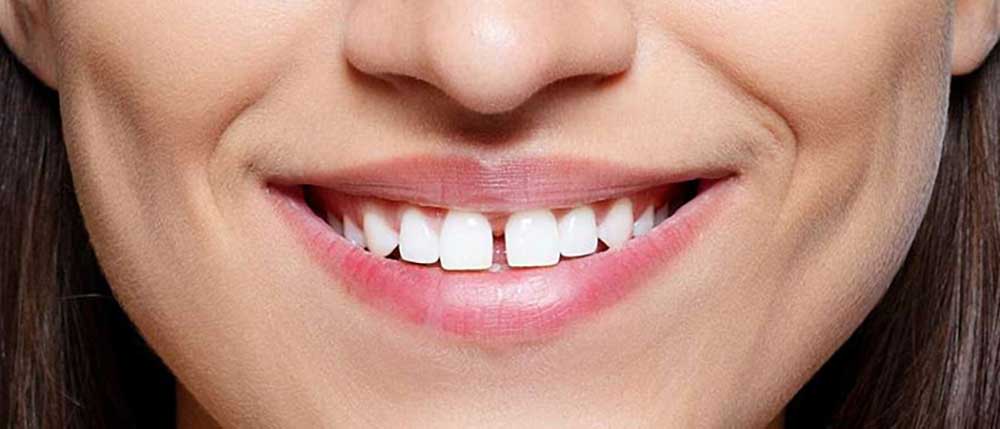 درمان فاصله بین دندان ها