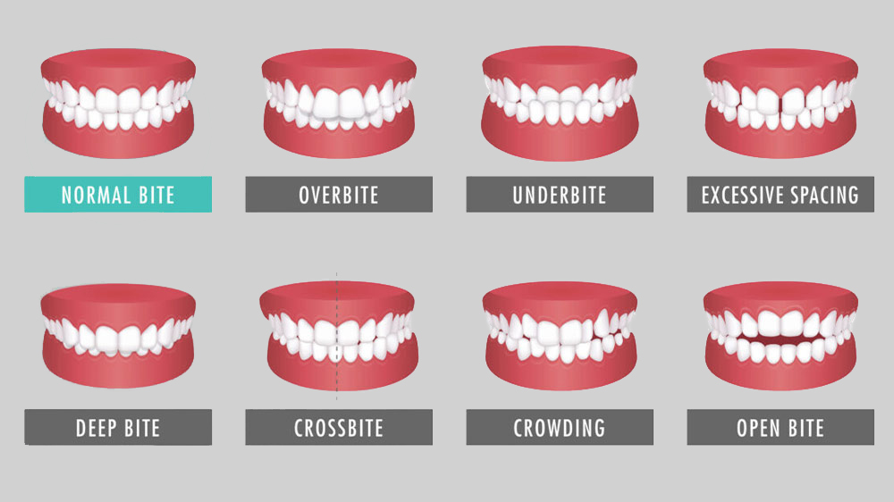 أنواع مشاكل الأسنان التي يمكن علاجها بتقويم الأسنان