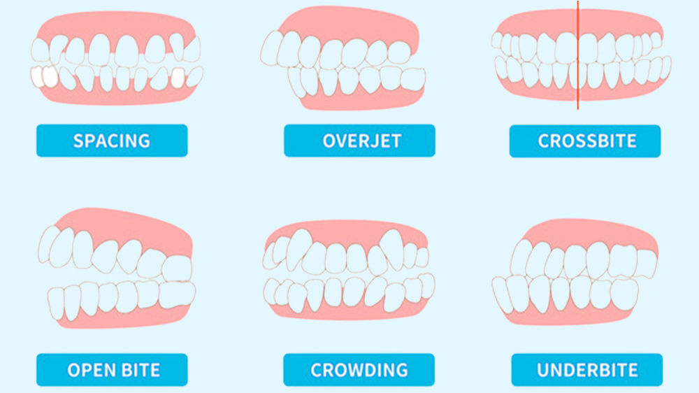 انواع مشکلات دندانی قابل درمان با ارتودنسی