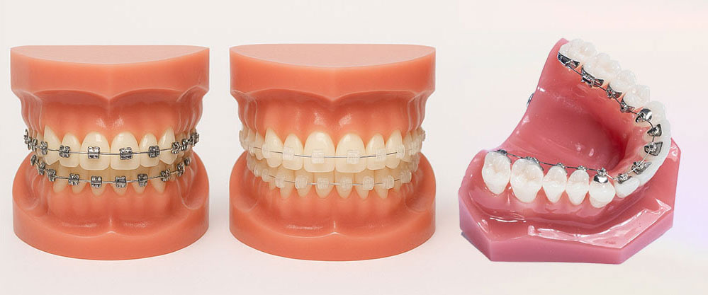 The three main types of fixed orthodontic appliances: metal, ceramic, and lingual.