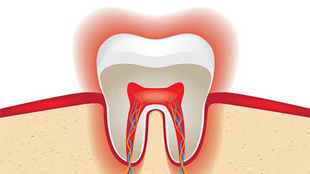 what is tooth sensitivity