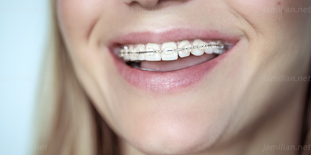 خانمی دارای ارتودنسی نامرئی با براکت همرنگ دندان