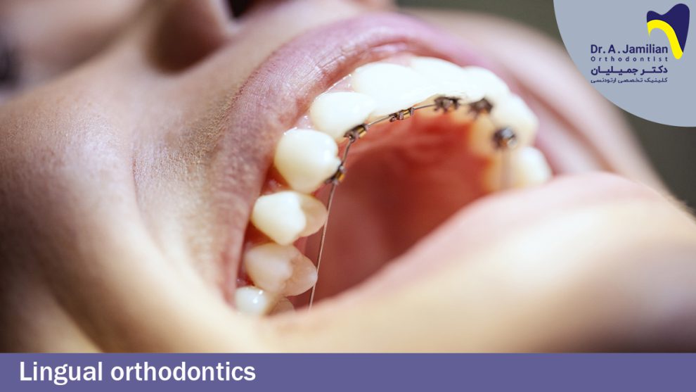 Lingual Orthodontics methods and advantages Dr Jamilian