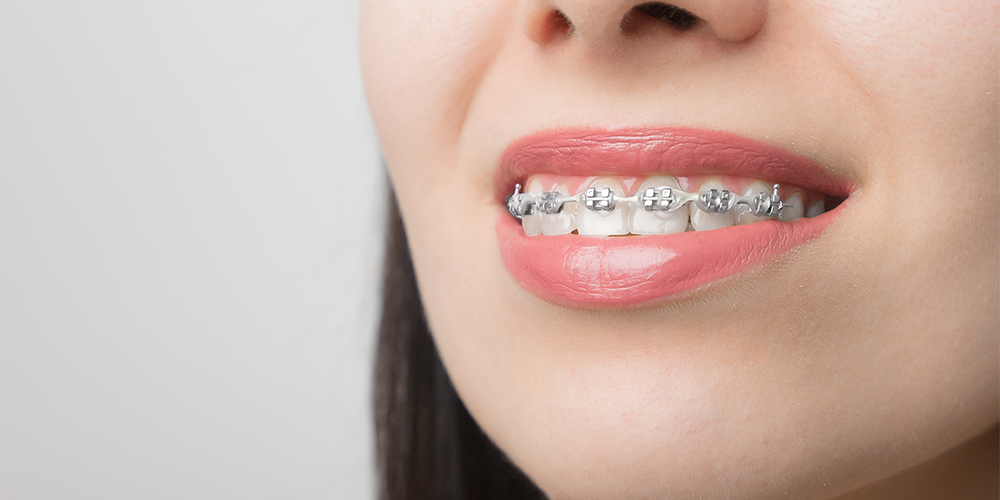 young woman smile with dental orthodontics brackets