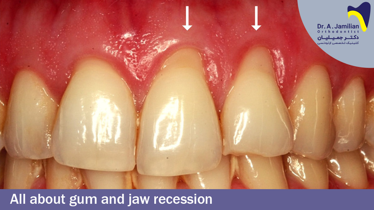 All About Gum and Jaw Recession - Dr Jamilian