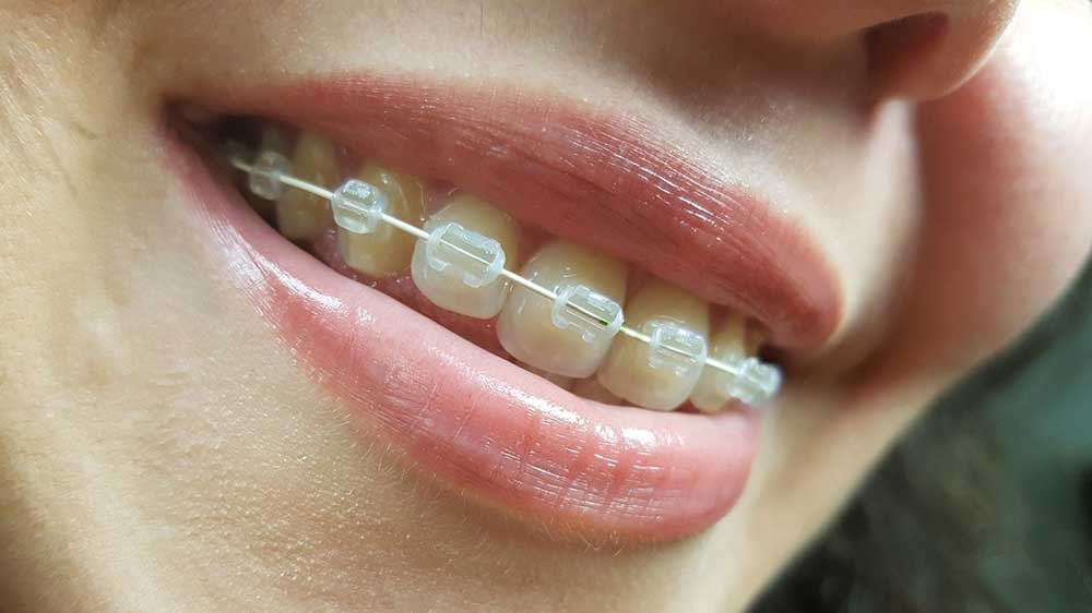 مزایای ارتودنسی با براکت های هم رنگ دندان