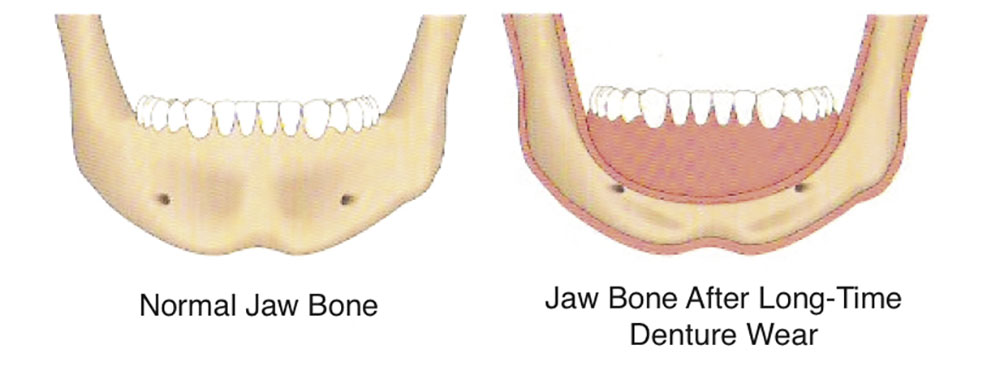 bone loss from denture