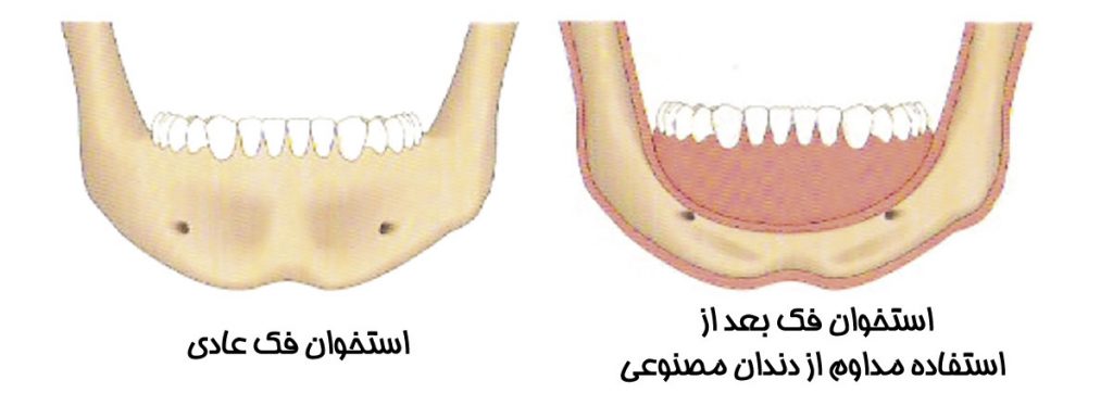 از دست رفتن استخوان به خاطر دندان مصنوعی